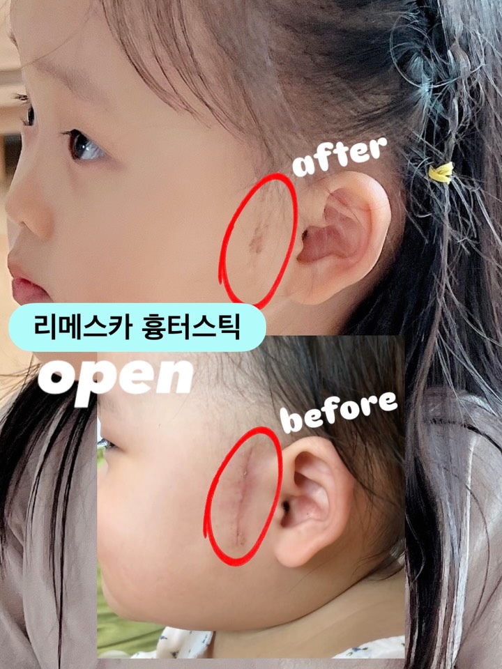 리메스카 흉터스틱